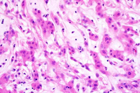 A microscopic image of chordoid glioma