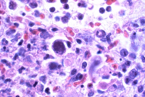 microscopic image of cytomegalovirus-infected cells