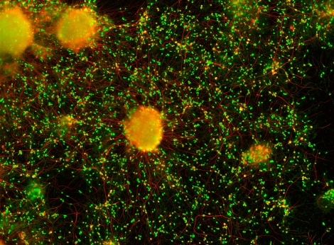 iPSC-derived neurons generated from tissue taken from human patients with Huntington's Disease