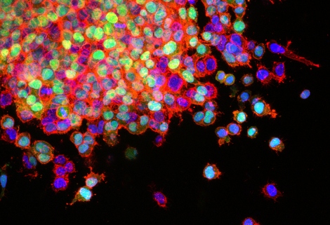 A microscopic image shpws lung cancer cells invading surrounding cells and starting to spread
