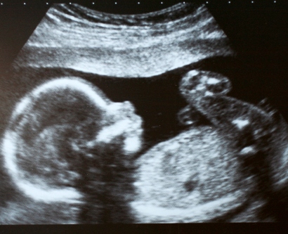 ultrasound image of a fetus