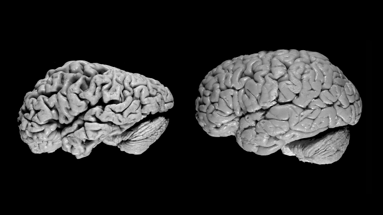 the brain of a person with Alzheimer's disease sits next to a normal brain