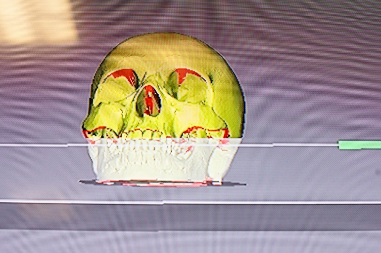 a computer screen shows a scan of a skull that will be turned into a 3-D printed model