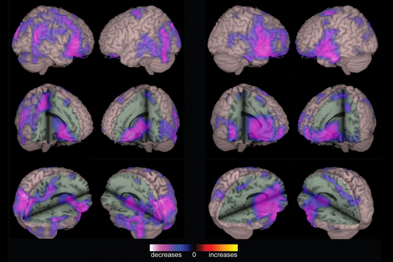 brain data from different angles, areas in purple are the regions of the brain where connectivity is significantly lower in patients with epilepsy, as compared to well patients.