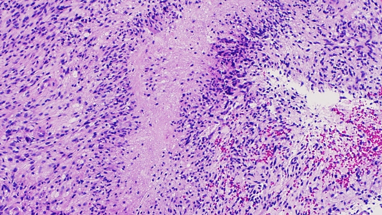 Science image of Glioblastoma characterized by "palisading necrosis".