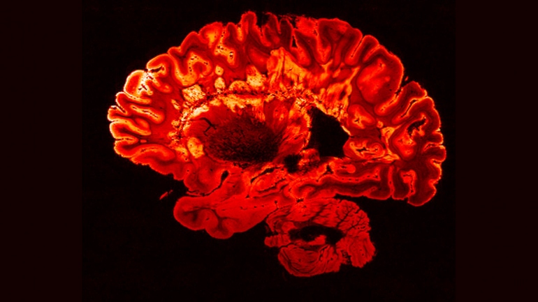 MRI scan of a person with MS. 