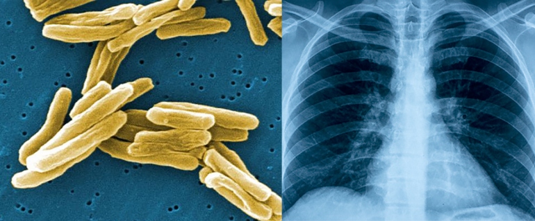 a microscopic image of tuberculosis next to an image of human lungs shown on an X-ray