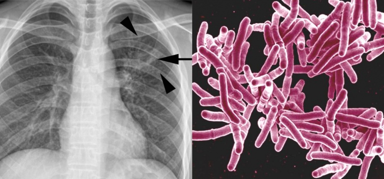 a chest X-ray of a patient with TB is shown alongside a microscopic image of Mycobacterium tuberculosis bacteria 