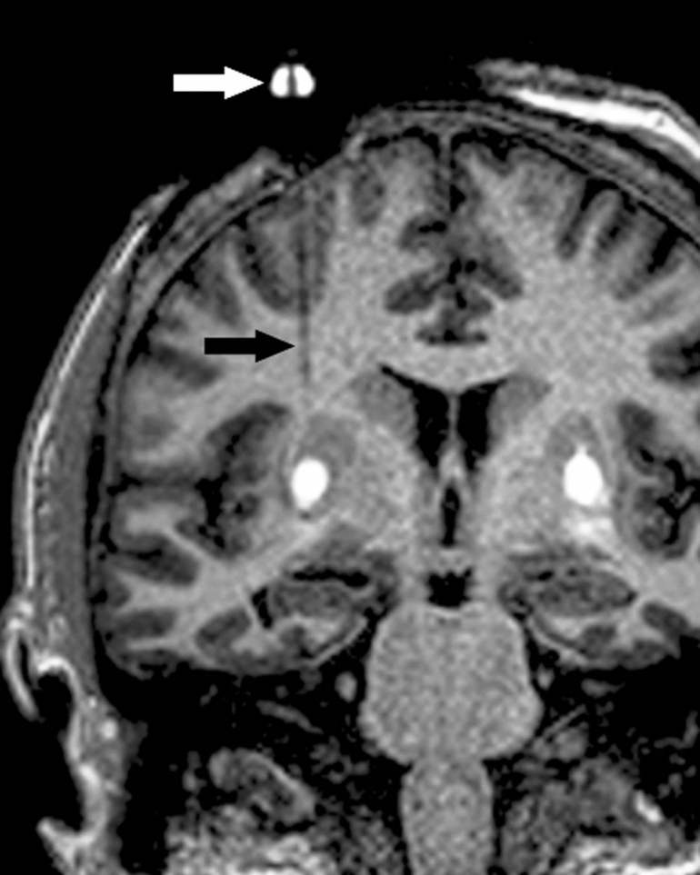 Brain MRI with a faint tube. 