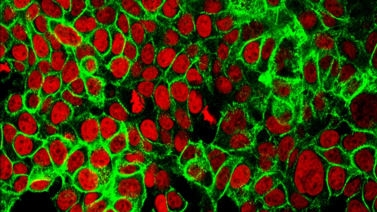 Colon cancer cells with the cell nuclei stained red and the protein E-cadherin stained green.
