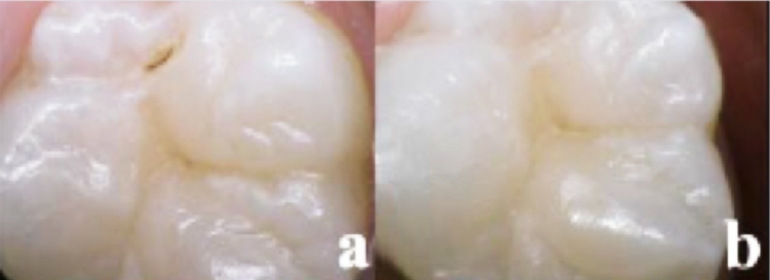 a tooth with a cavity is shown next to the same tooth without the cavity six months later