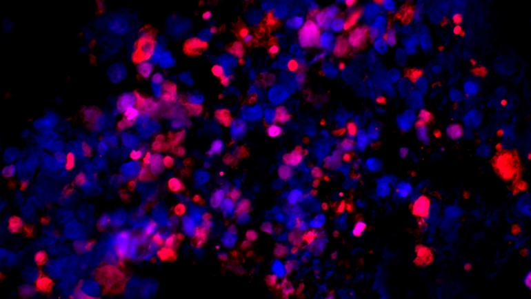 Cell image of metastatic human prostate cancer cells, in red, killed by ISRIB.