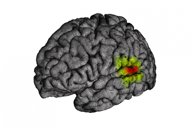 An image of a brain shows the superior temporal gyrus.