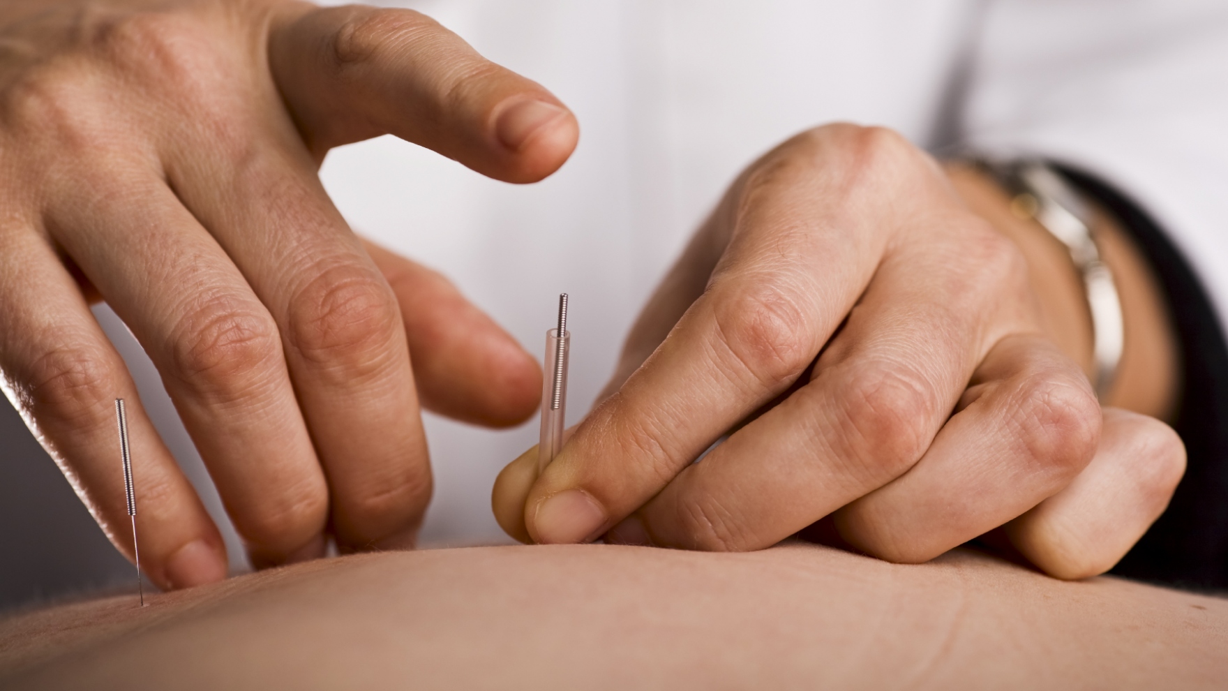 Acupuncture Helps Pediatric Patients Manage Pain and ...
