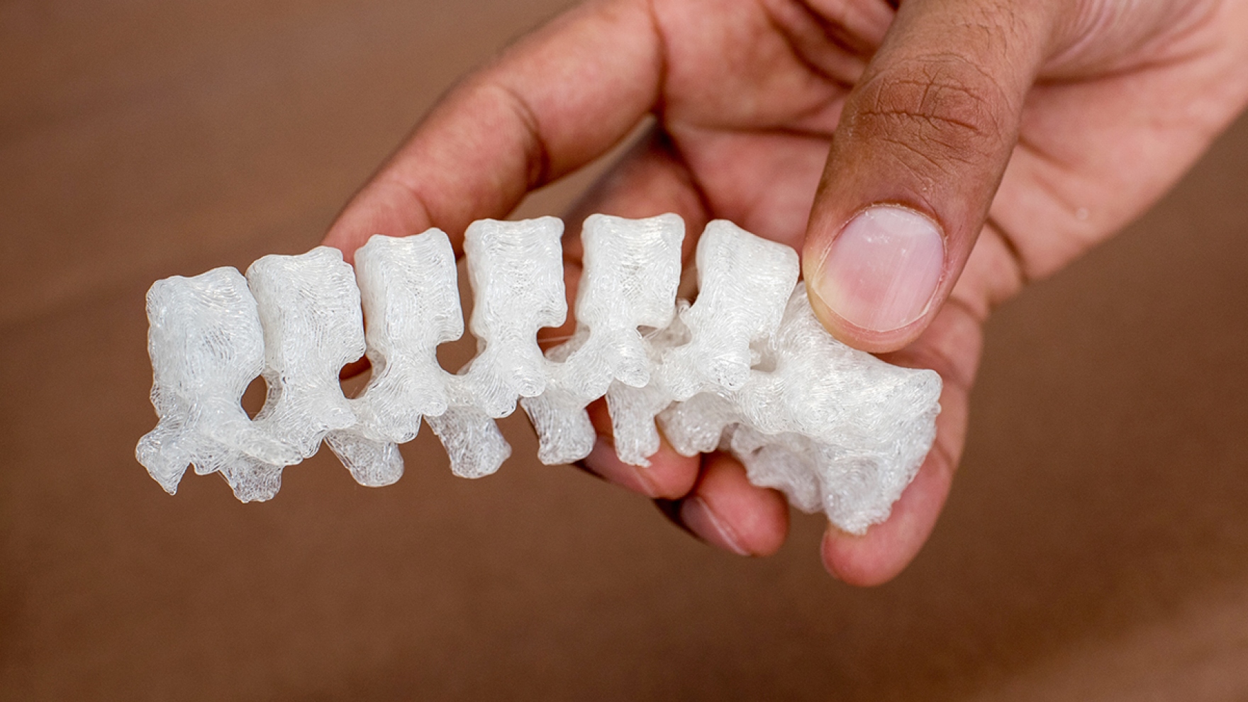 3D Printed Bones Are Helping Doctors Prepare For Surgeries UC San 
