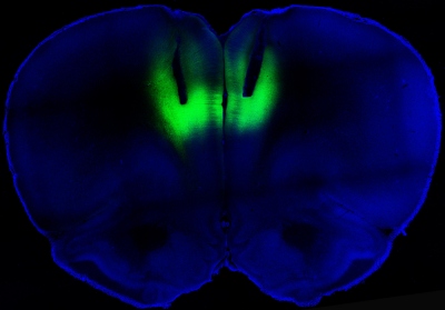 Laser light delivered through fiberoptic cables directed at the prefrontal cortex