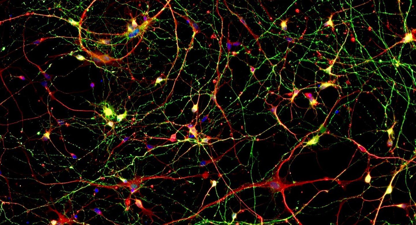 microscopic image of neurons and accumulation of phosphorylated tau protein