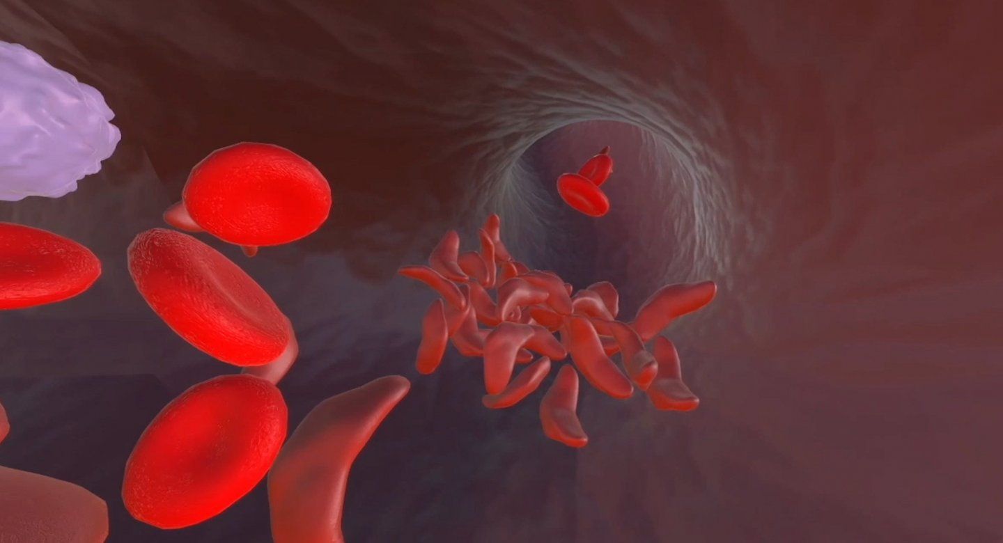 Illustration of sickle cells moving through a vein