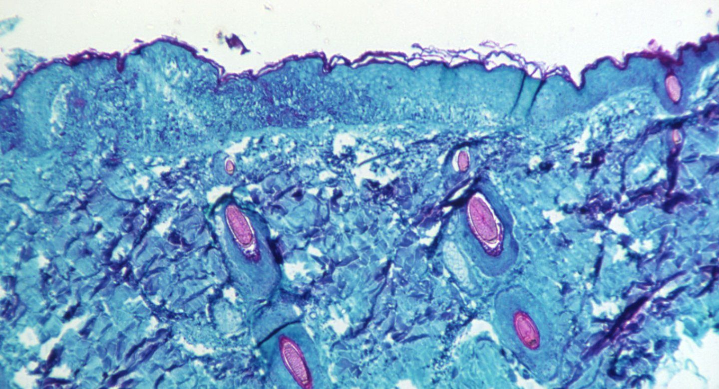 Microscopic image of tissue harvested from a lesion on the skin of a monkey infected with the monkeypox virus.