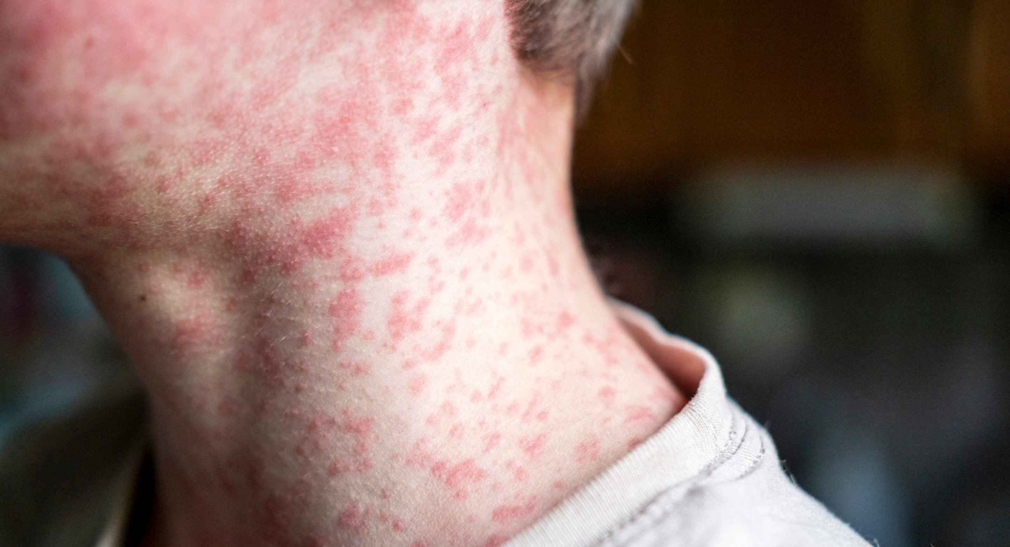Close-up of a measles rash on a person's neck, showing flat, red, blotchy spots.