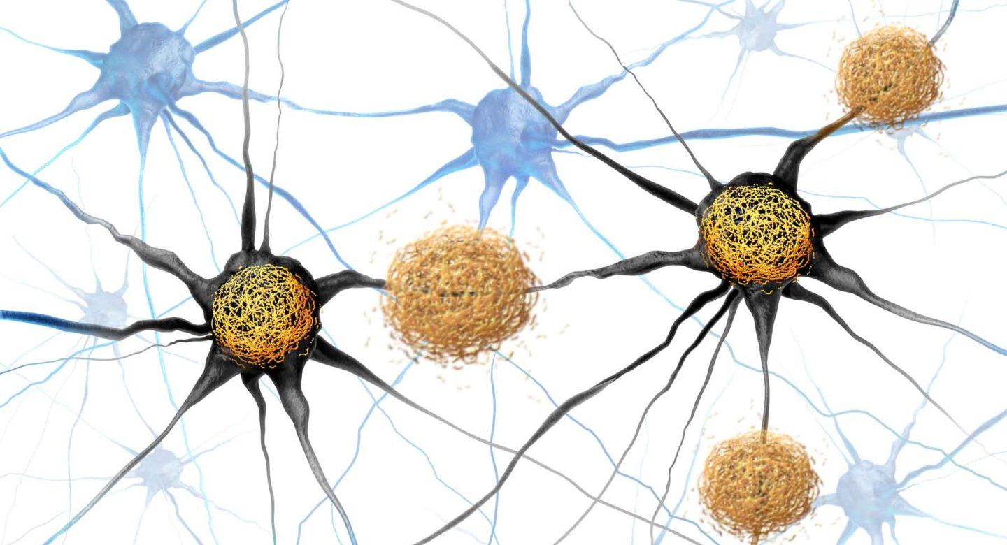 Conceptual illustration of amyloid beta and tau tangles as abnormal clusters of protein fragments that accumulate between nerve cells and inside neuron cells in the brain resulting in degenerative disease as Alzheimers and dementia.