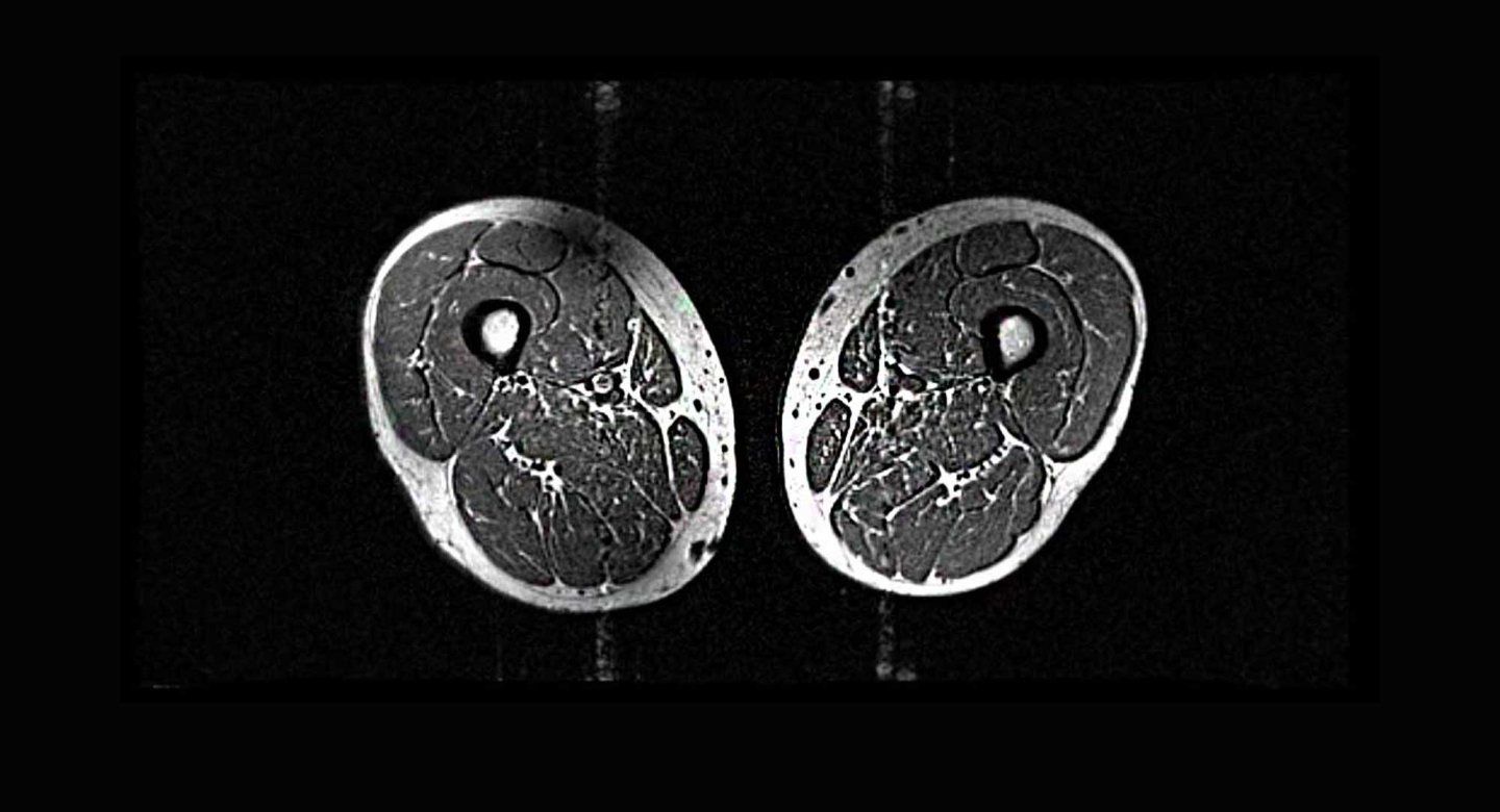 M R I scans showing cross sections of thigh muscles.