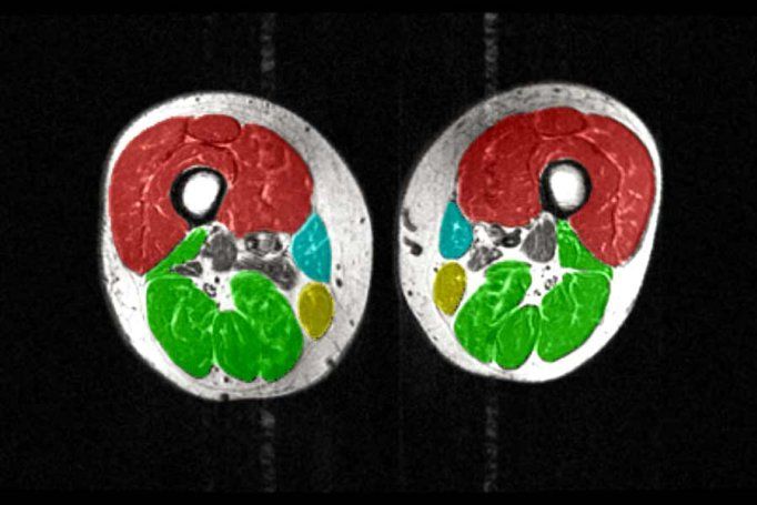 MRI image of the thighs with color-coded muscle groups, showing less muscle volume.