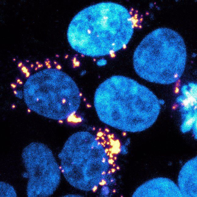 Microscopy of blue cells with clumps of yellow proteins, indicating contact with prion forms of amyloid beta