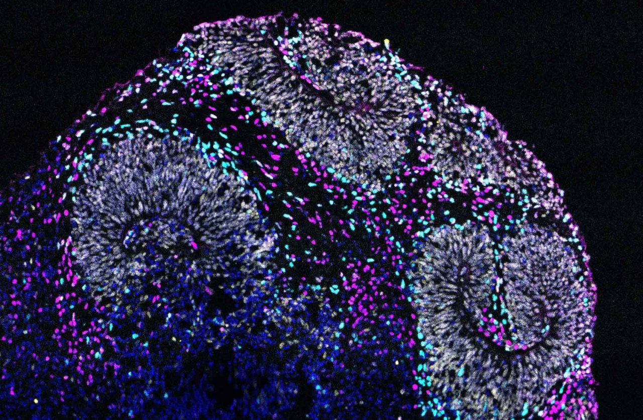 Microscope image of a brain organoid derived from human stem cells that contain a mutation associated with autism spectrum disorder.