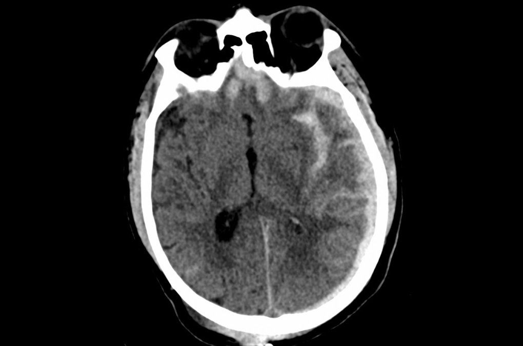 A CT scan of a brain with a traumatic injury