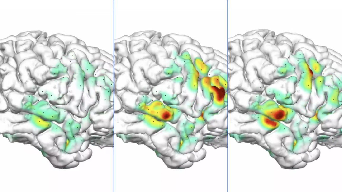 Map of brain activity during a seizure over time