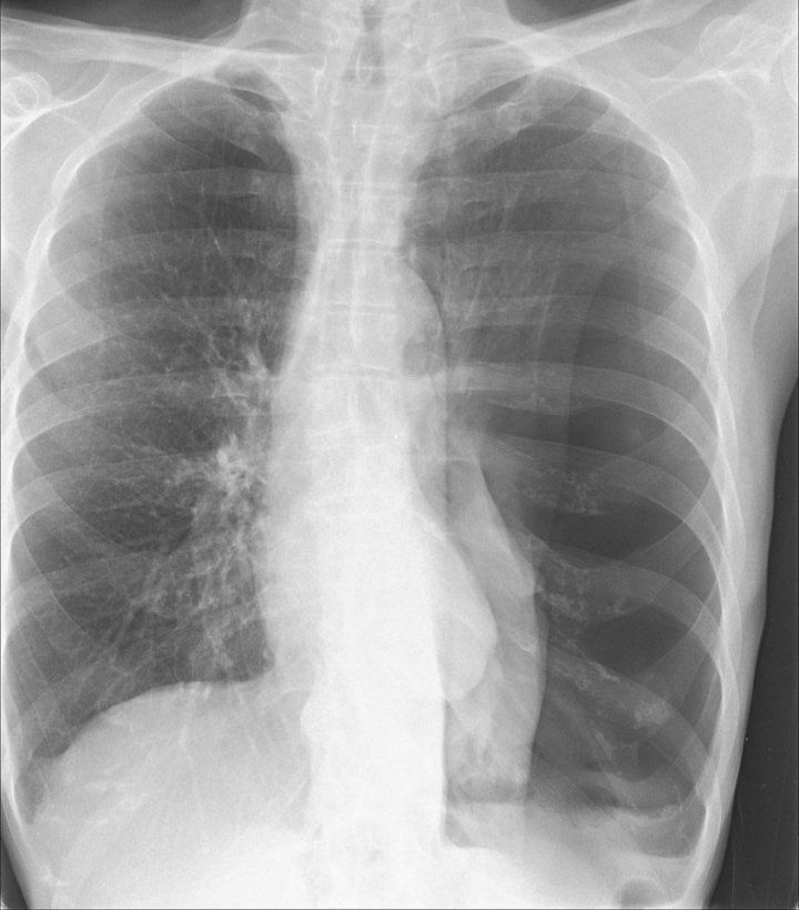 Chest X-ray showing pneumothorax