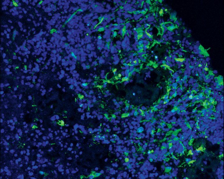 microscope image of green glioblastoma cells and blue brain organoids