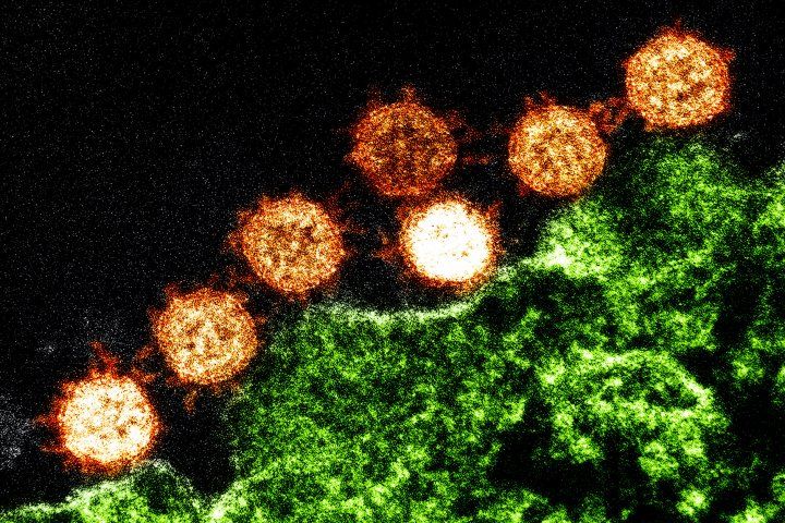 Microscopic image of SARS coronaviruses