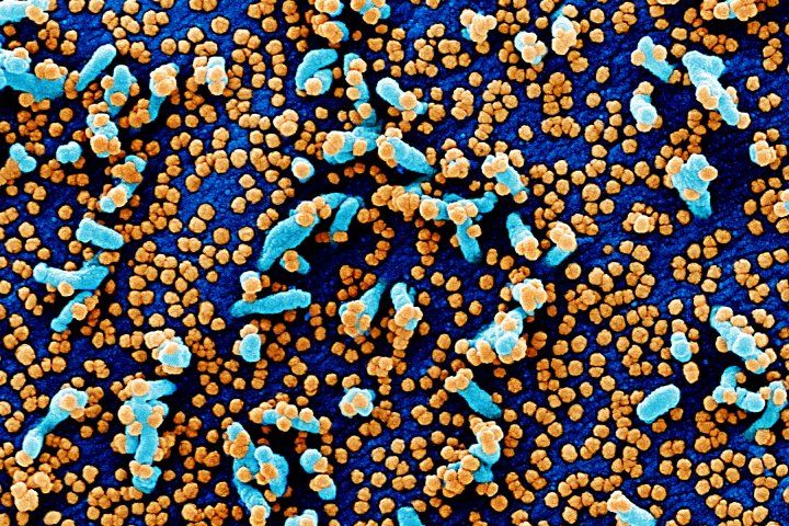 the novel coronavirus surrounds cells in an eletron microscope image
