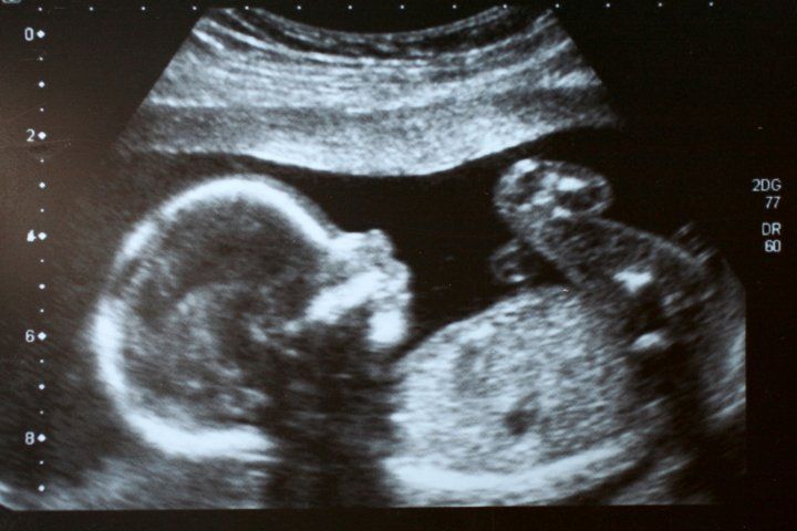 Black and white ultrasound of fetus
