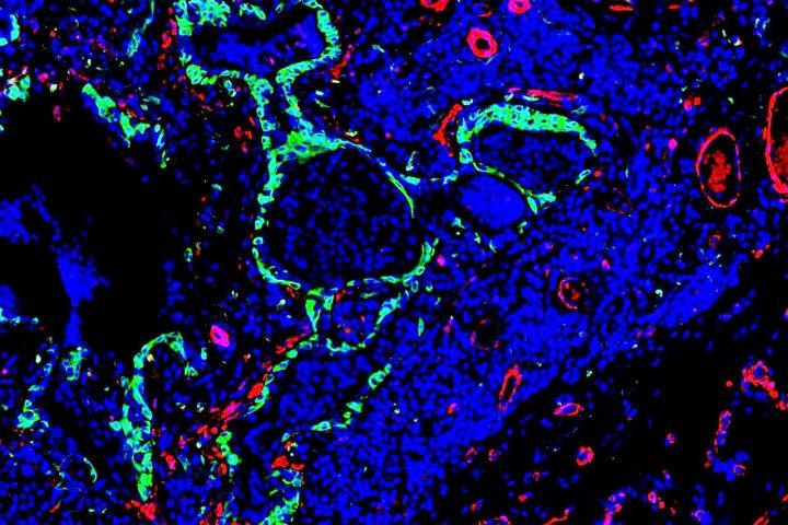 microscopic image shows gree stained abnomal stem cells near scar-forming fibroblasts