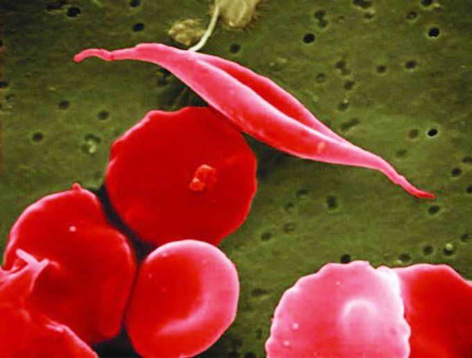 red blood cell that has taken on a crescent (sickle) shape