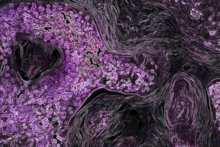 microscopic image of Kras-driven lung cancer in a mouse model