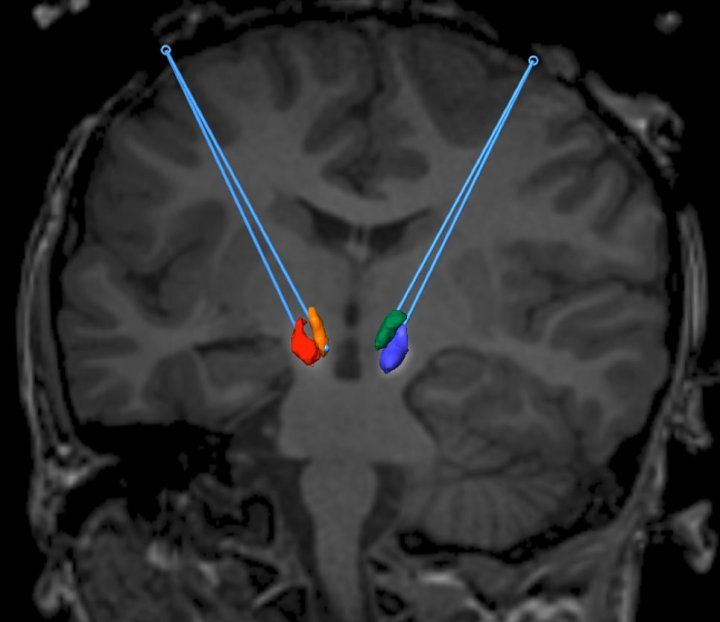 Brain image showing location of AADC targets