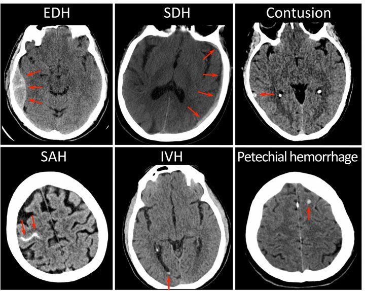 Black-and-white CT images of brains with signs of concussion