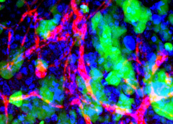Blood vessels (red), cell nuclei (blue), and human metastatic breast cancer cells (green) in a mouse's brain