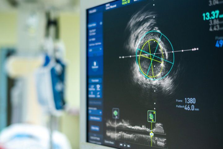 Intravascular ultrasound imaging (IVUS) at cardiac catheterization laboratory room