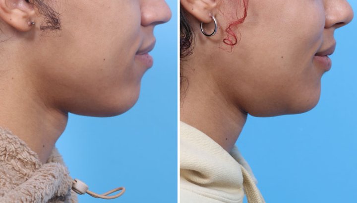 2. Hormones and surgery can alter the appearance of the Adam's apple