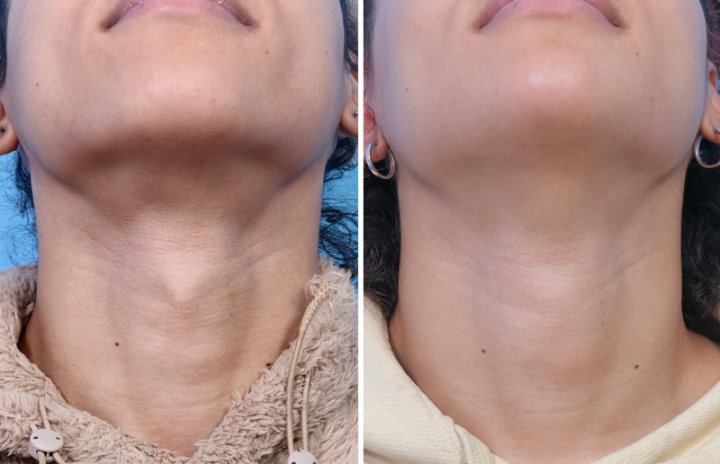 Side by side view of patient who underwent adam's apple surgery. Left image is before surgery, and the right image is after. There is no neck incision scar.