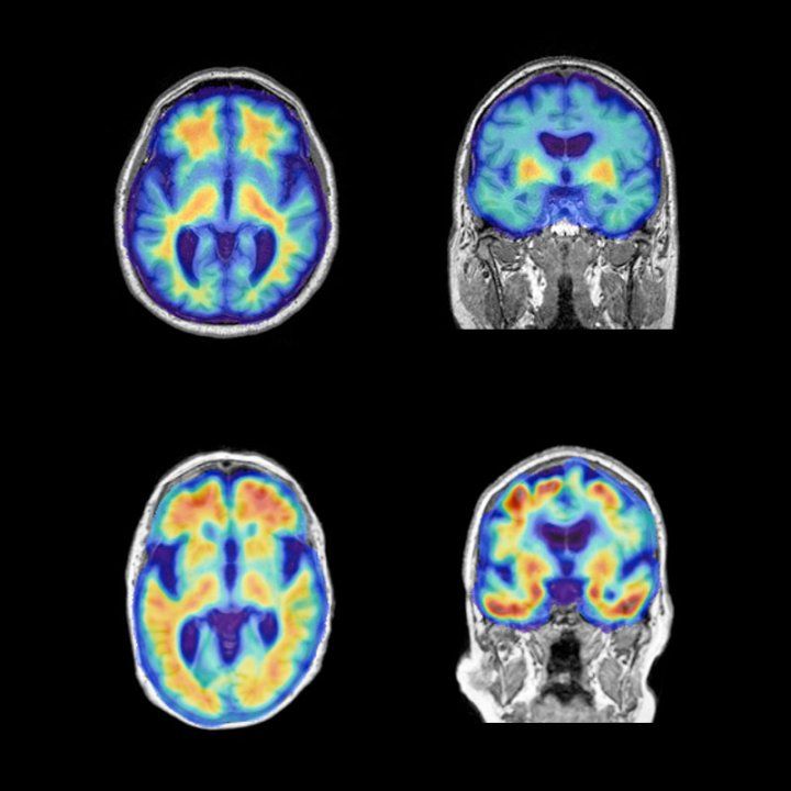 An image showing four brain PET scans, with orange areas representing Alzheimer's progression