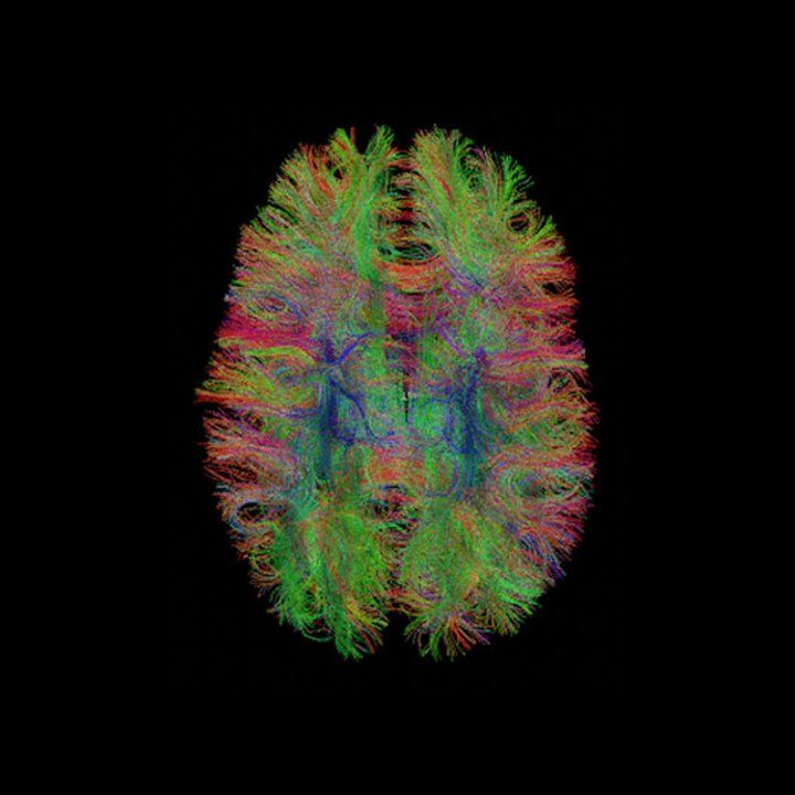 A tractography of an overhead view of a brain. White matter bundles are represented by multi-colored fibers
