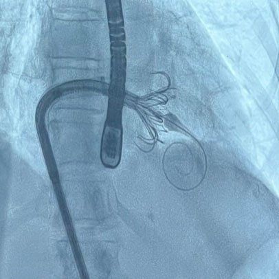 A tricuspid device is implanted on the heart with a catheter.
