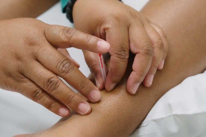 A nurse gently inserts an acupuncture needle into a child's leg.