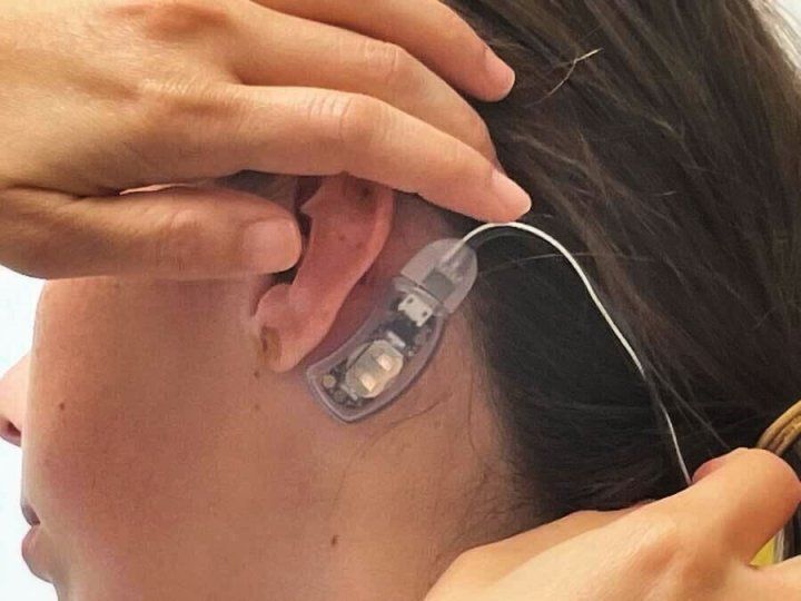 A health practicioner holds a small device near a girl's ear. The device, IB-Stim, will target the nervous system to reduce pain from irritable bowel syndrome (IBS).